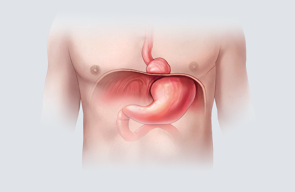 ¿Qué es la hernia de hiato? Causas, síntomas y tratamiento